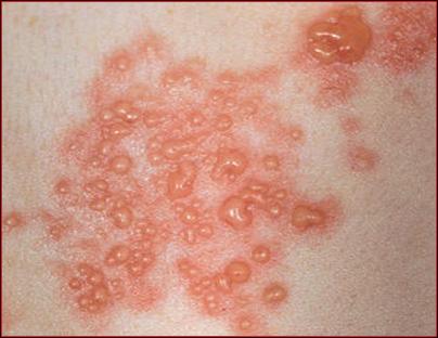 infected eczema